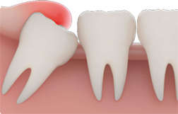 wisdom tooth extraction