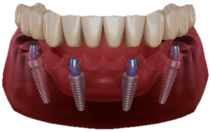 All-On-4® Full Mouth Dental Implants